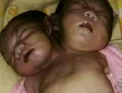 Nyawa Bayi Terlahir Satu Tubuh Dua Kepala Tidak Tertolong