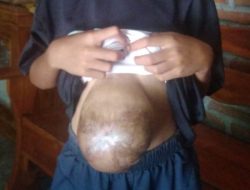 Alami Pembesaran Usus, Ikhsan Iman Afriliansyah Butuh Uluran Tangan dari Para Donatur