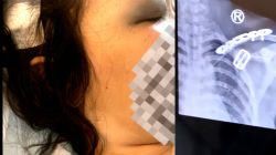 Pasien RS Hermina Grand Wisata Bekasi Diduga Alami Malapraktik Usai Operasi Cabut Gigi