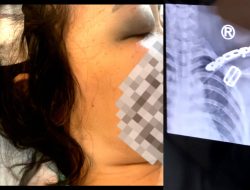 Pasien RS Hermina Grand Wisata Bekasi Diduga Alami Malapraktik Usai Operasi Cabut Gigi